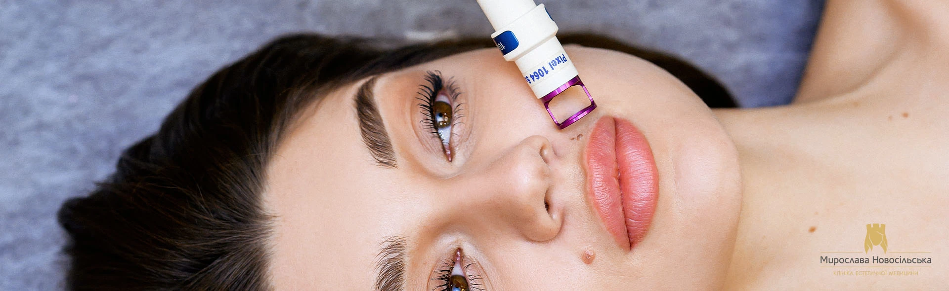 Laser mole removal, photo 1