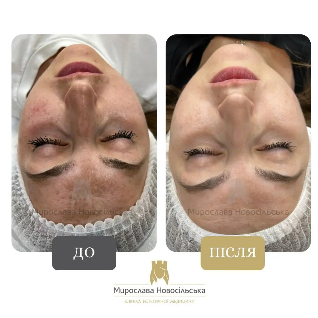 Лазерне видалення пігментних плям на обличчі, фото 9