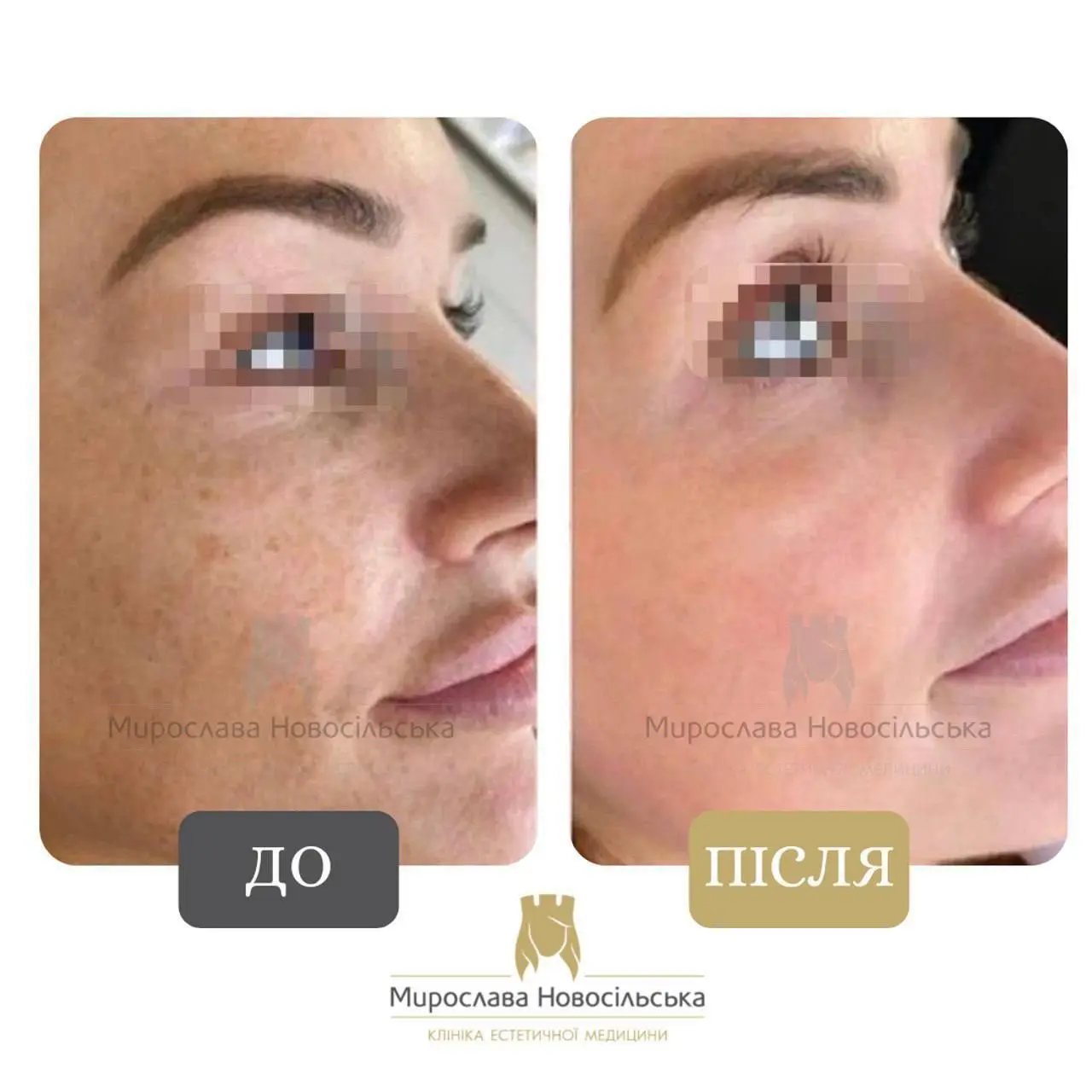 Лазерне видалення пігментних плям на обличчі, фото 8