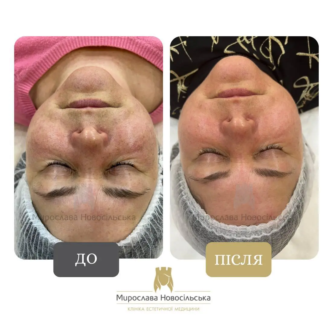 Лазерне видалення пігментних плям на обличчі, фото 7