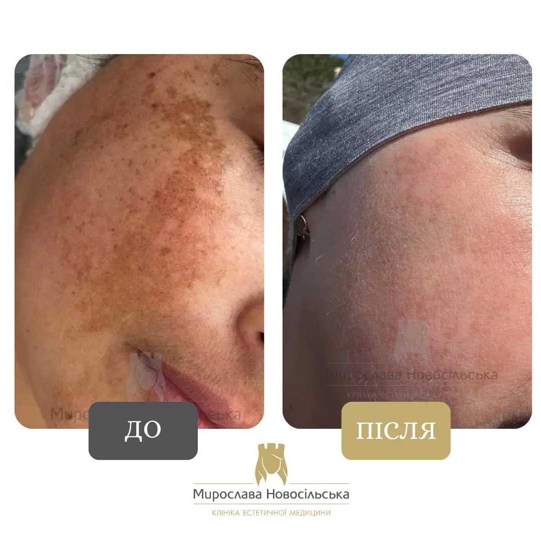 Лазерне видалення пігментних плям на обличчі, фото 6