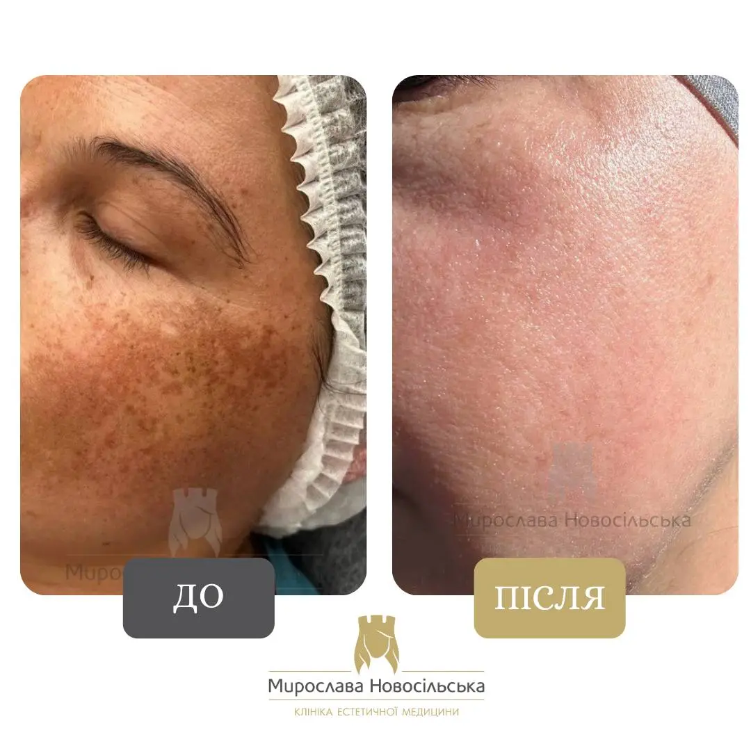 Лазерне видалення пігментних плям на обличчі, фото 5
