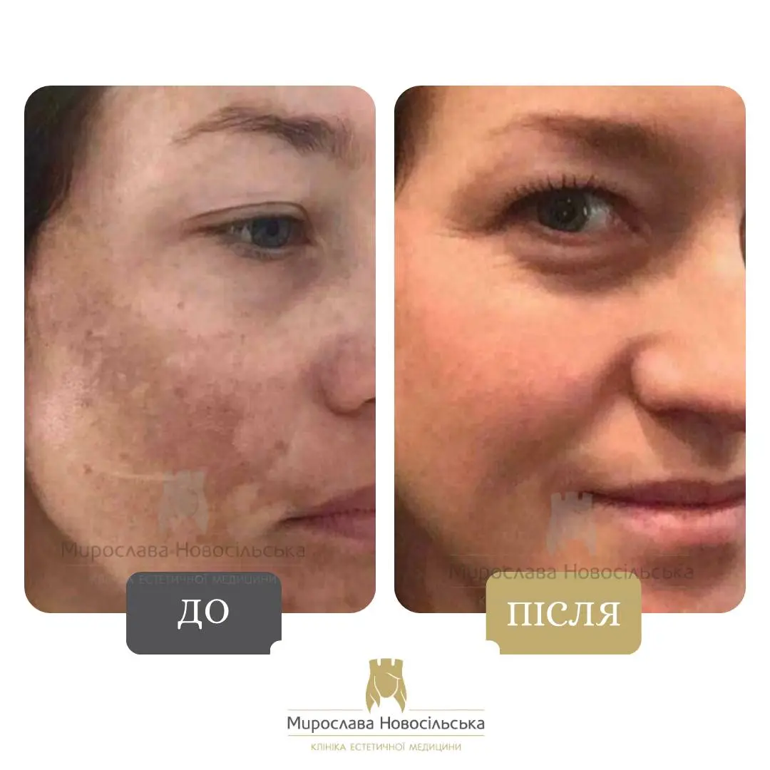 Лазерне видалення пігментних плям на обличчі, фото 10