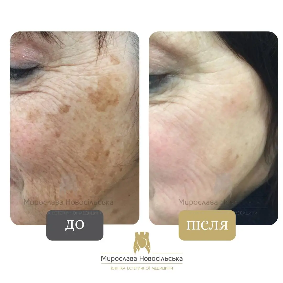 Лазерне видалення пігментних плям на обличчі, фото 3