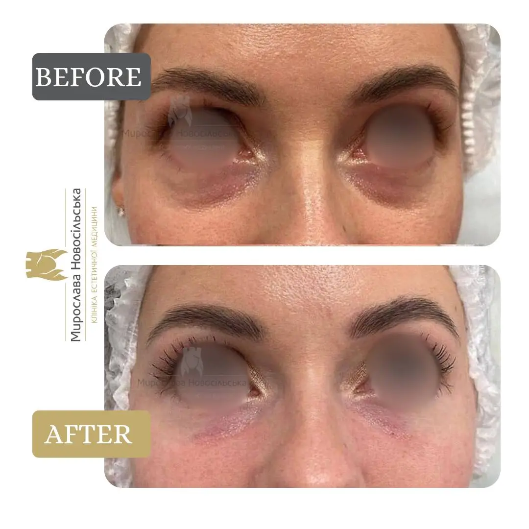 Biorevitalization of the area around the eyes