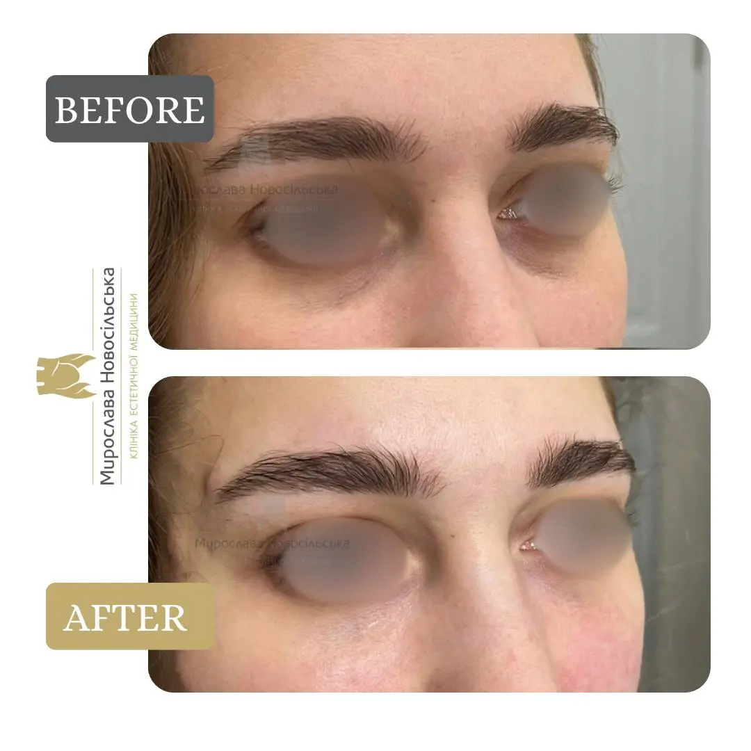 Biorevitalization of the area around the eyes
