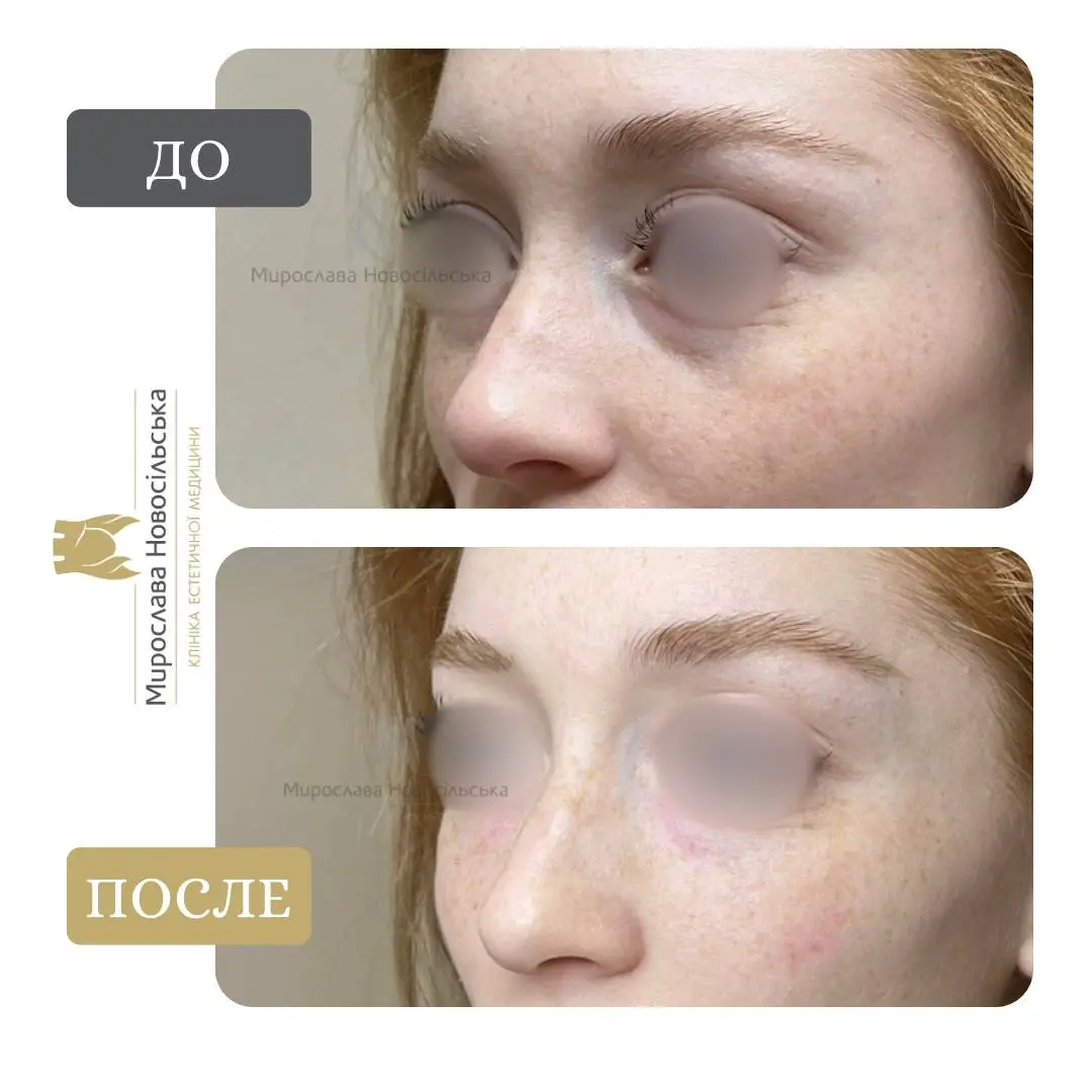 Биоревитализация, фото 3