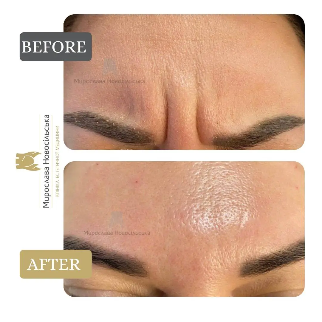 Botulinum Toxin Injections