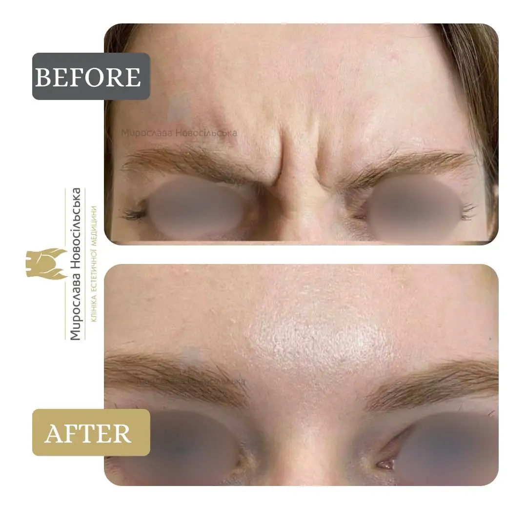 Botulinum Toxin Injections