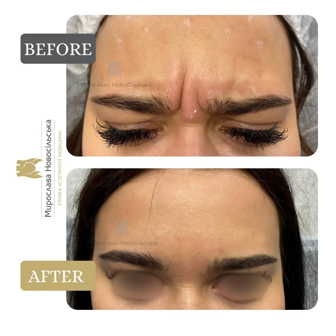 Xeomin injections, photo 2