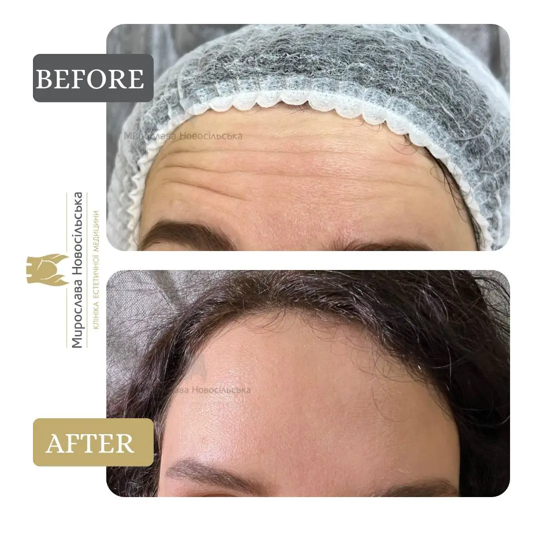 Xeomin injections, photo 4