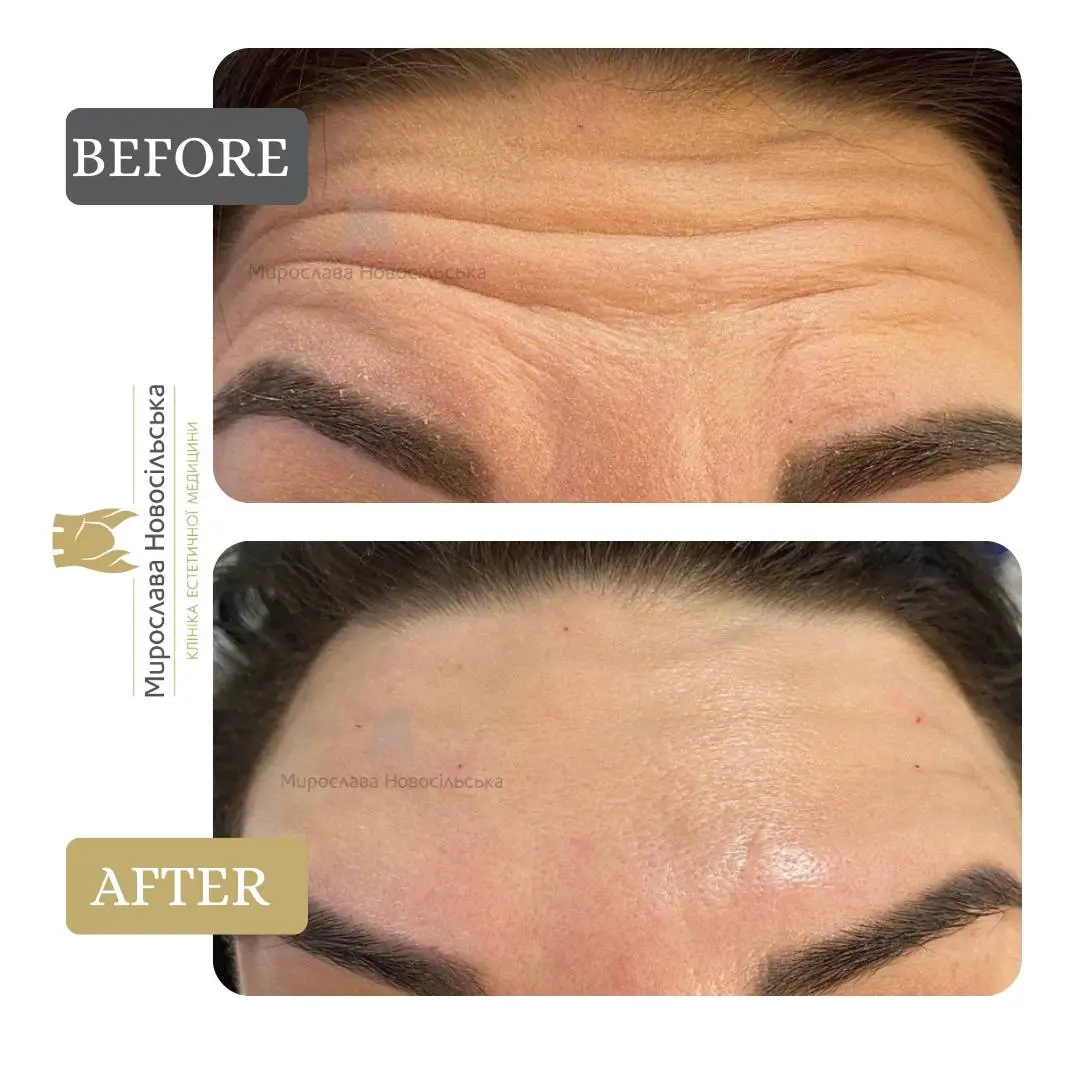 Xeomin injections, photo 3