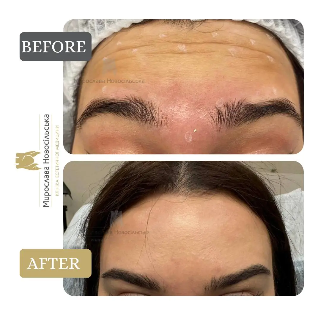 Botulinum Toxin Injections