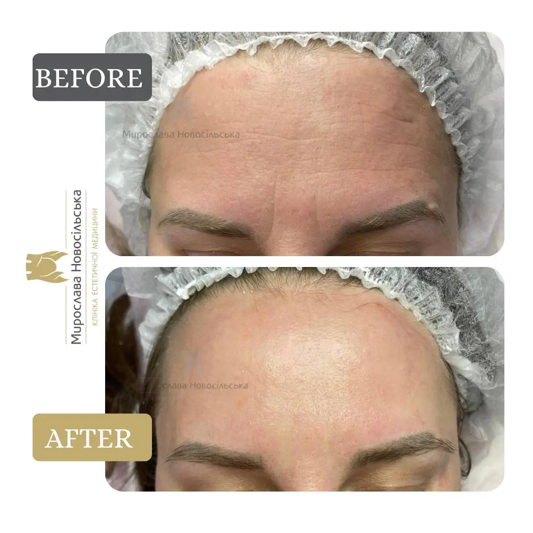 Botulinum Toxin Injections