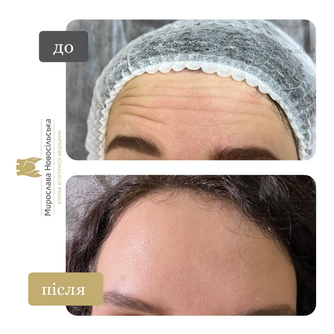 Ін’єкції Ксеоміну, фото 4