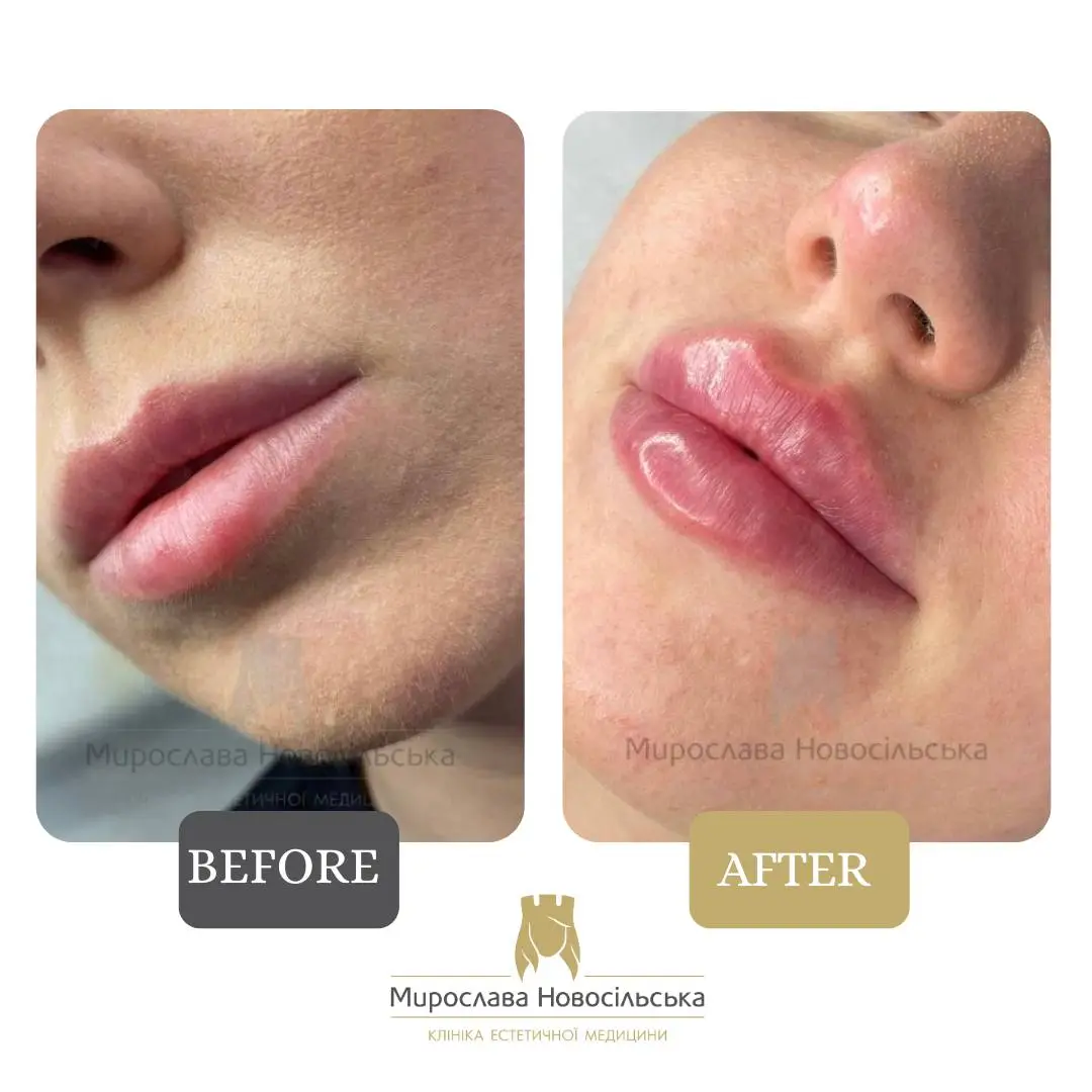 Lip fillers