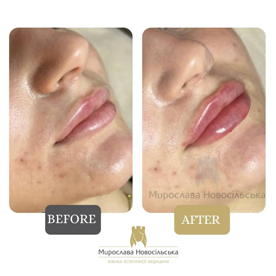 Facial fillers, photo 14