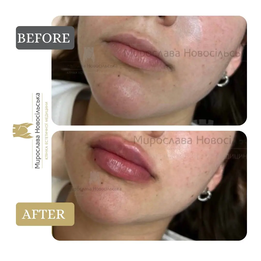 Facial fillers, photo 11