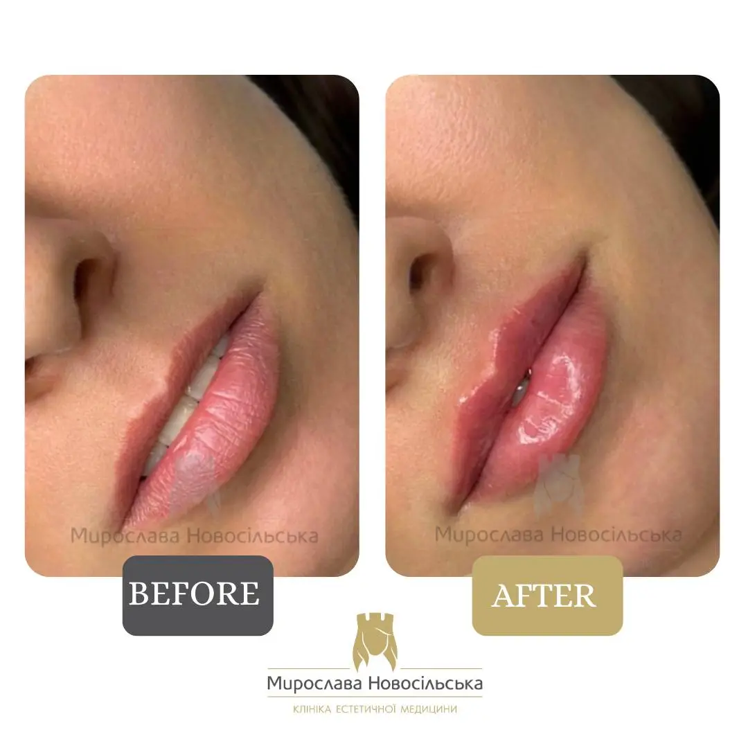 Facial fillers, photo 15