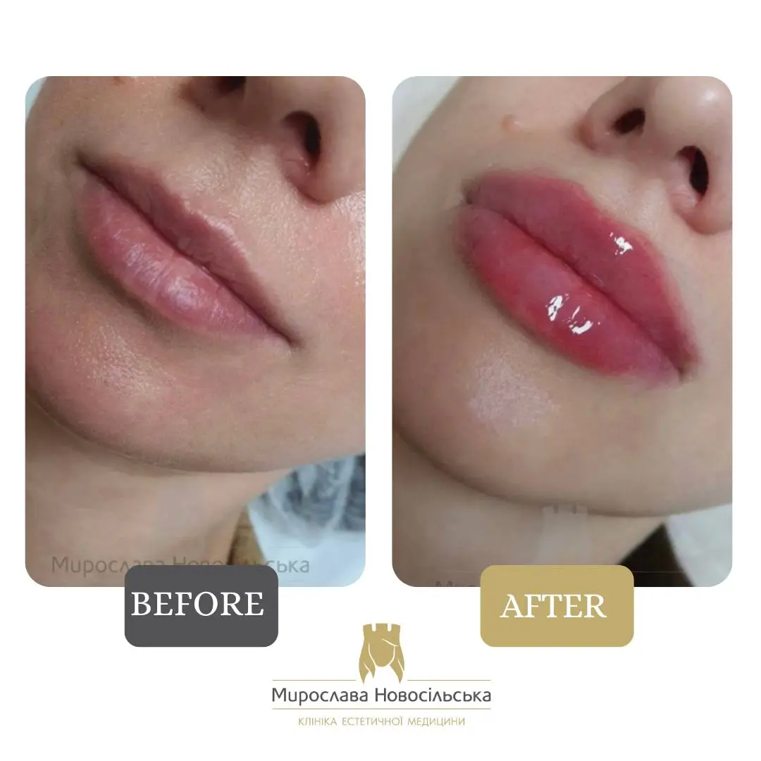 Facial fillers, photo 17