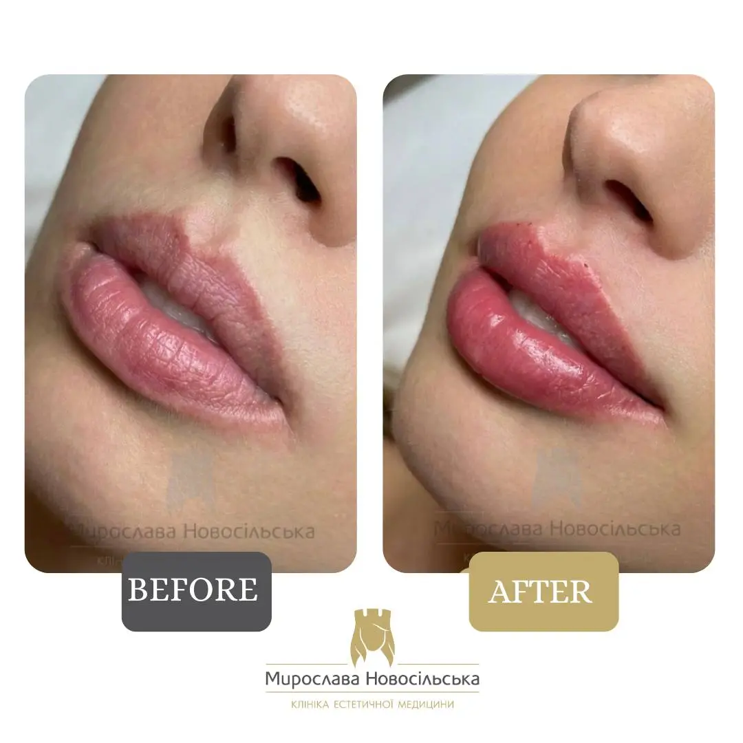 Facial fillers, photo 16