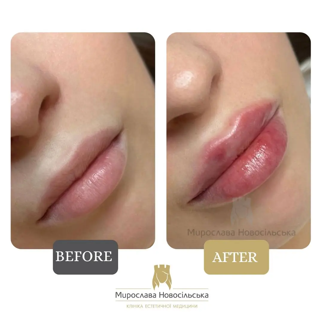 Lip fillers