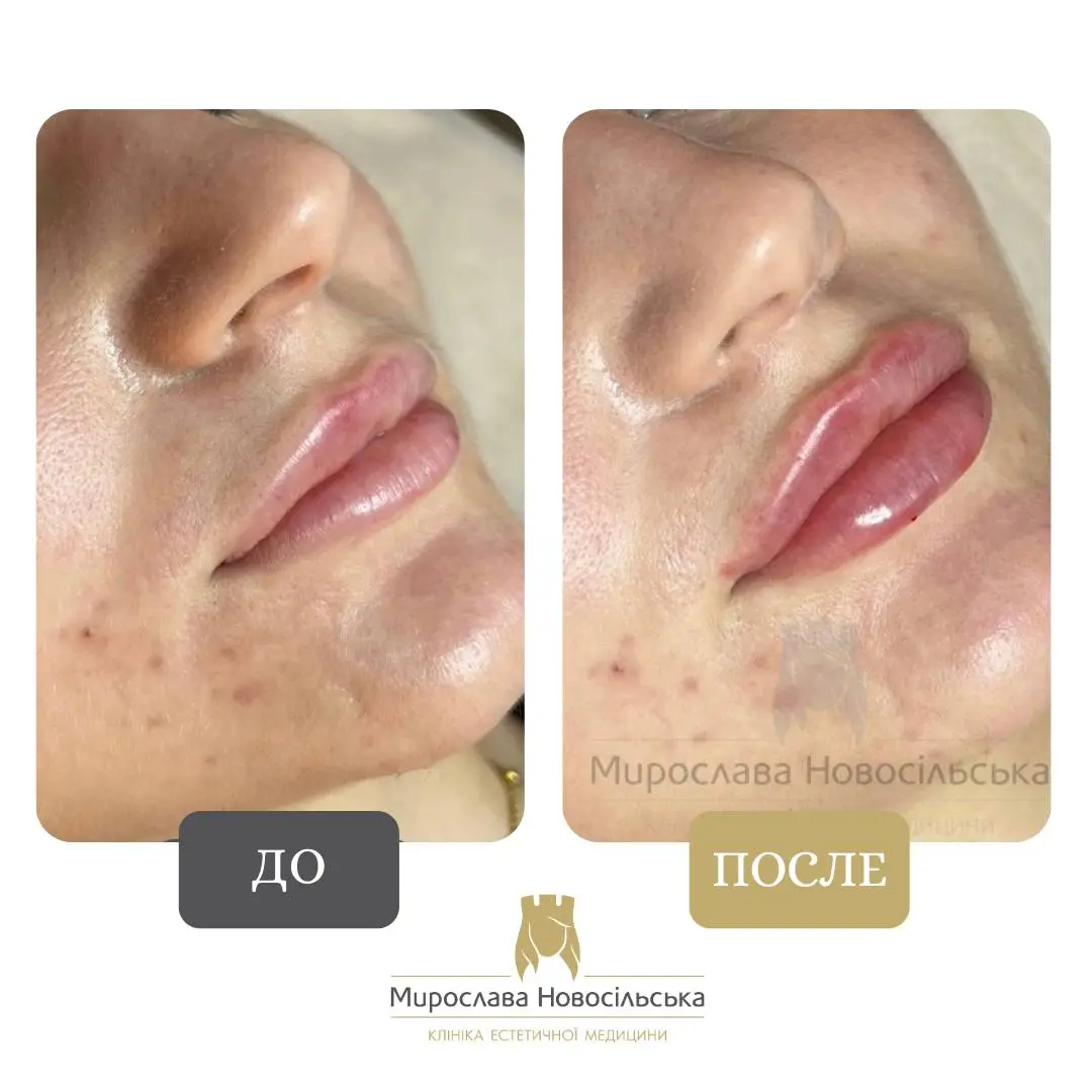 Филлеры для губ, фото 8