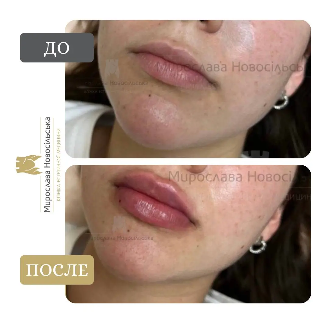 Филлеры для губ, фото 3
