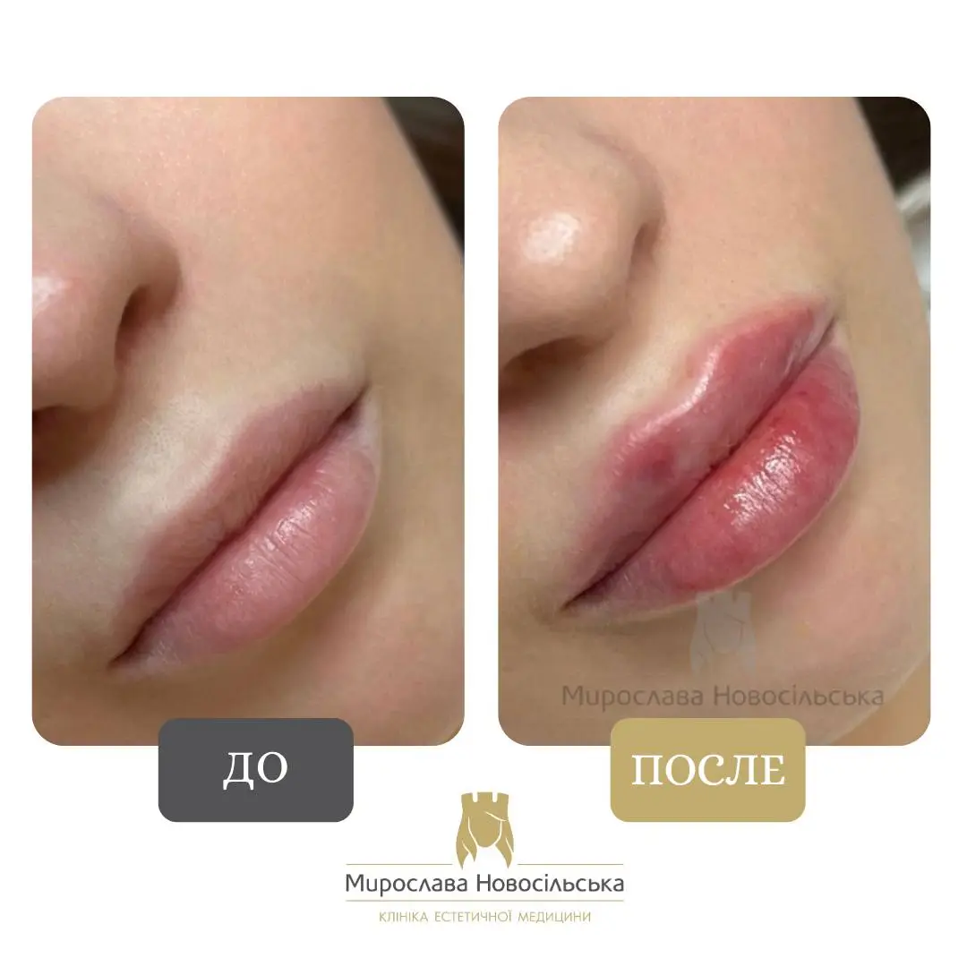 Филлеры для губ, фото 4