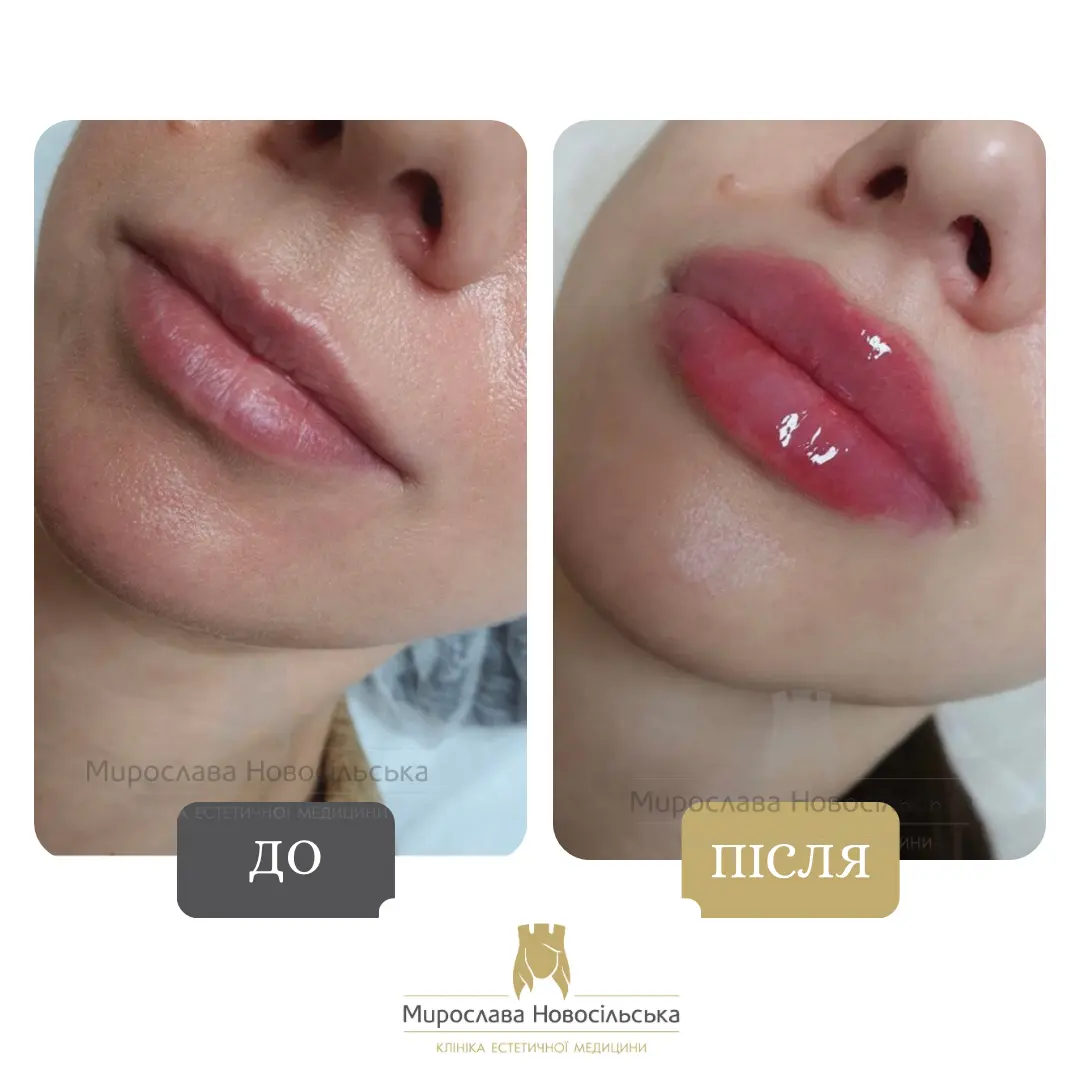 Філери для губ, фото 5