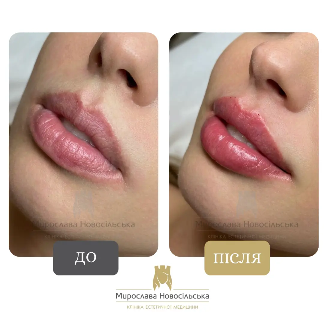 Філери для губ, фото 6