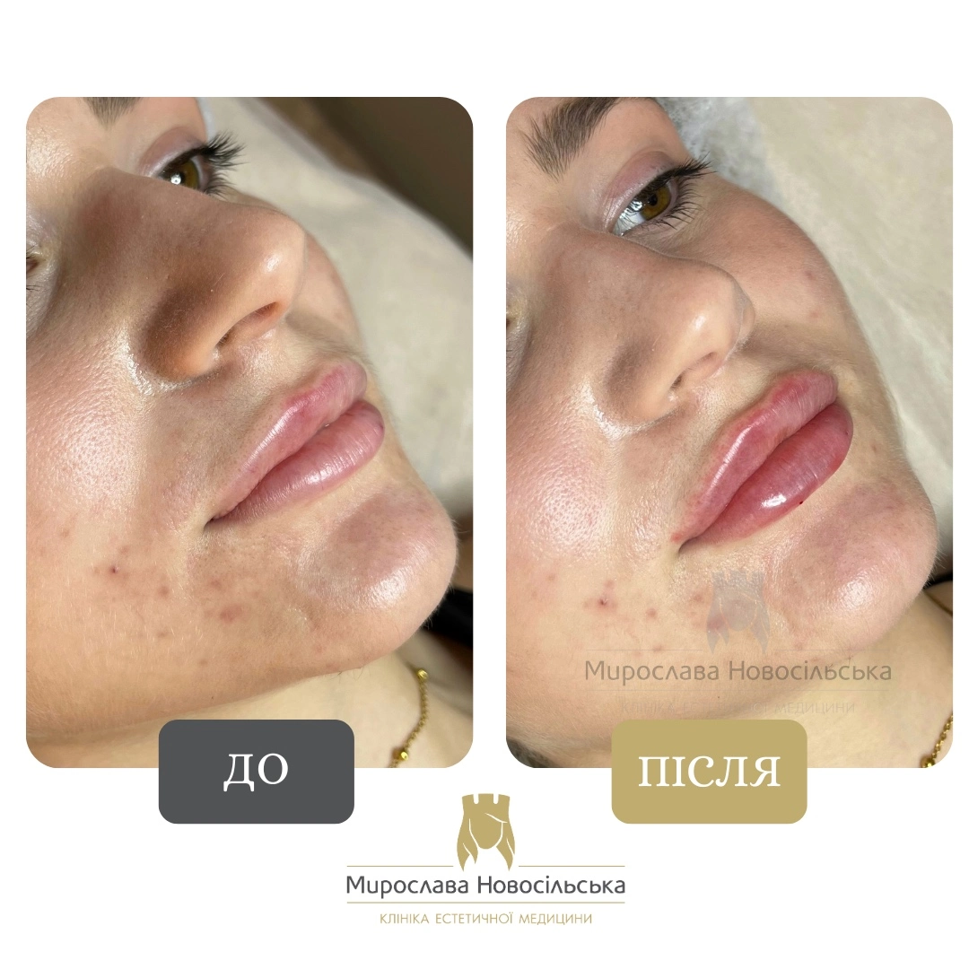 Філери для губ, фото 8