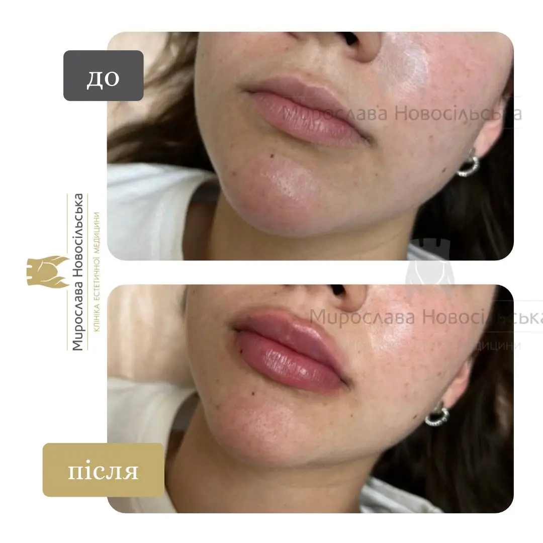 Філери для губ, фото 3