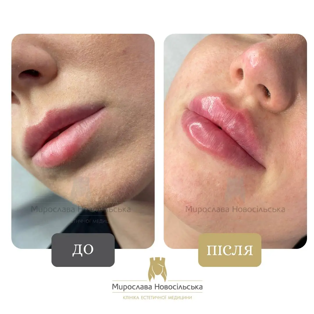 Філери для губ, фото 2