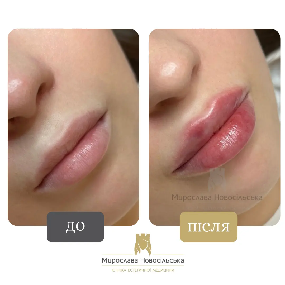 Філери для губ, фото 4