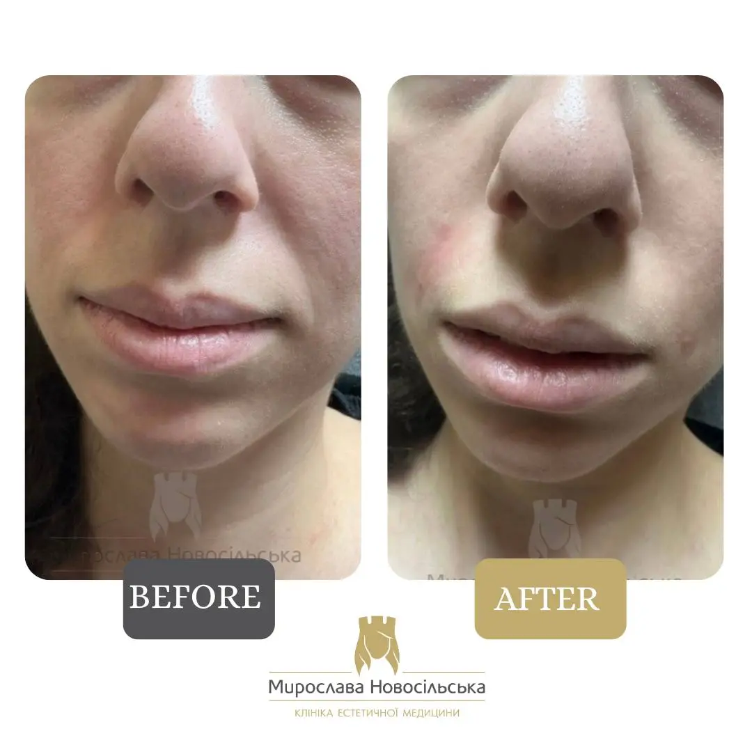 Fillers in nasolabial folds, photo 2