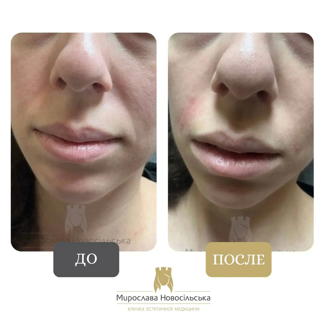 Филлеры в носогубку, фото 2