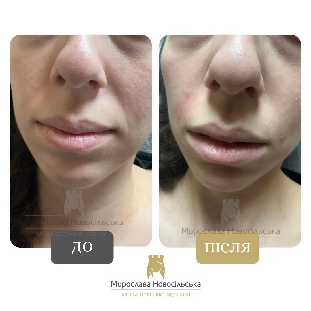 Філери в носогубні складки, фото 2