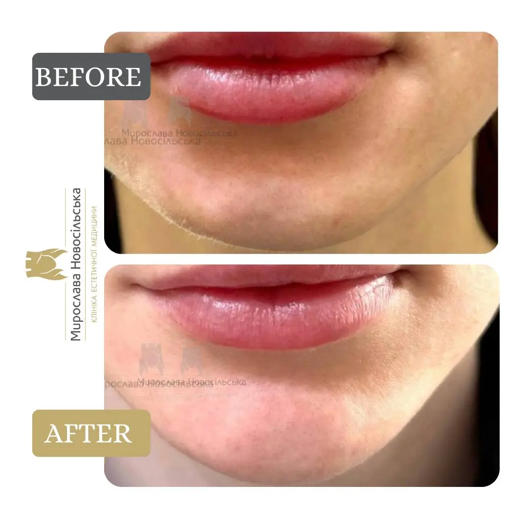 Facial fillers, photo 8