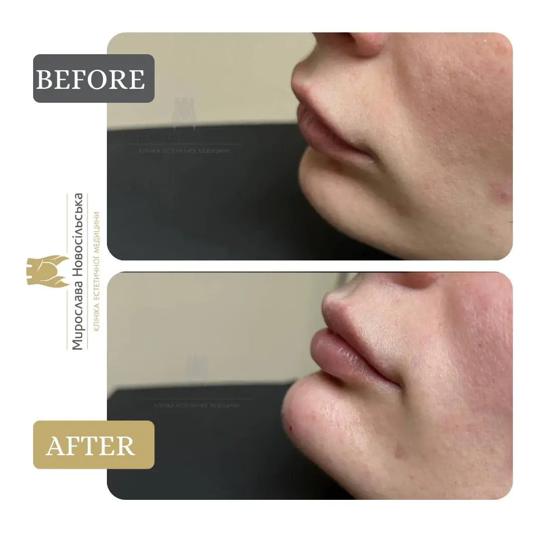 Facial fillers, photo 9