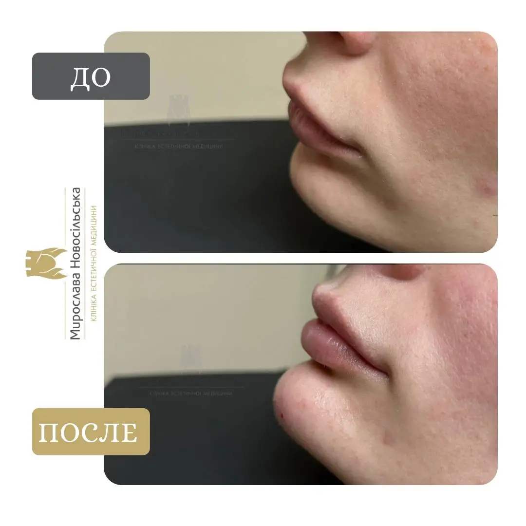 Контурная пластика подбородка, фото 3