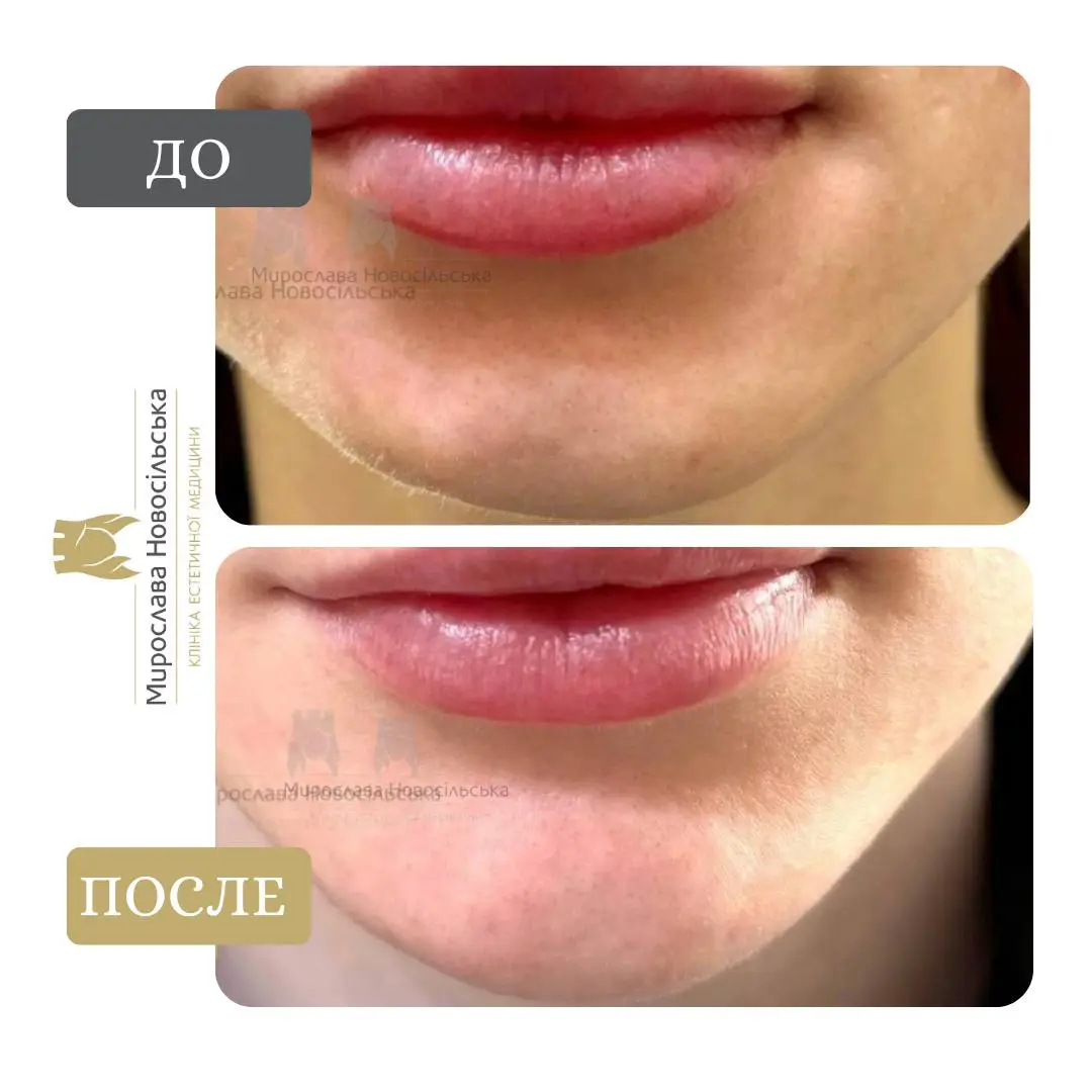 Контурная пластика подбородка, фото 2