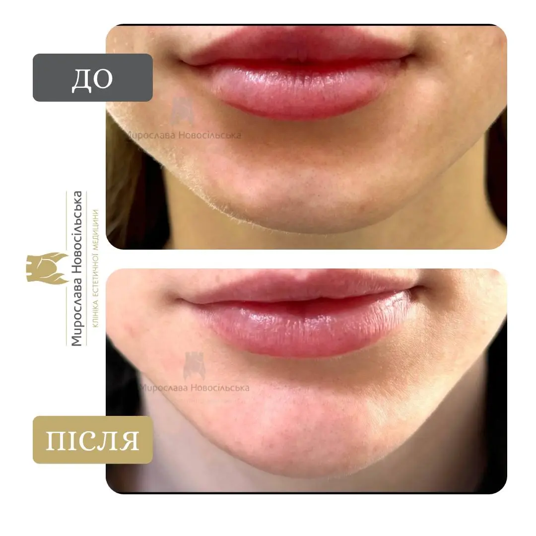 Контурна пластика підборіддя, фото 2