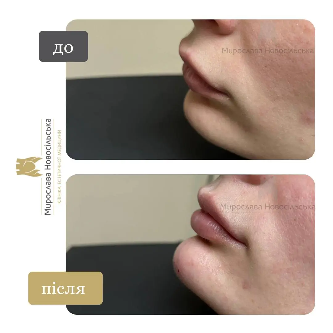 Контурна пластика підборіддя, фото 3