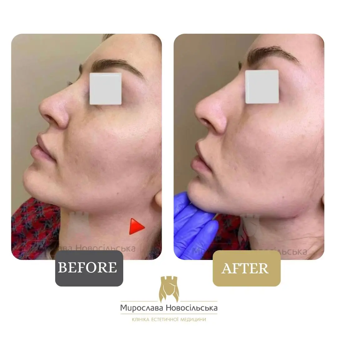 Facial fillers, photo 10