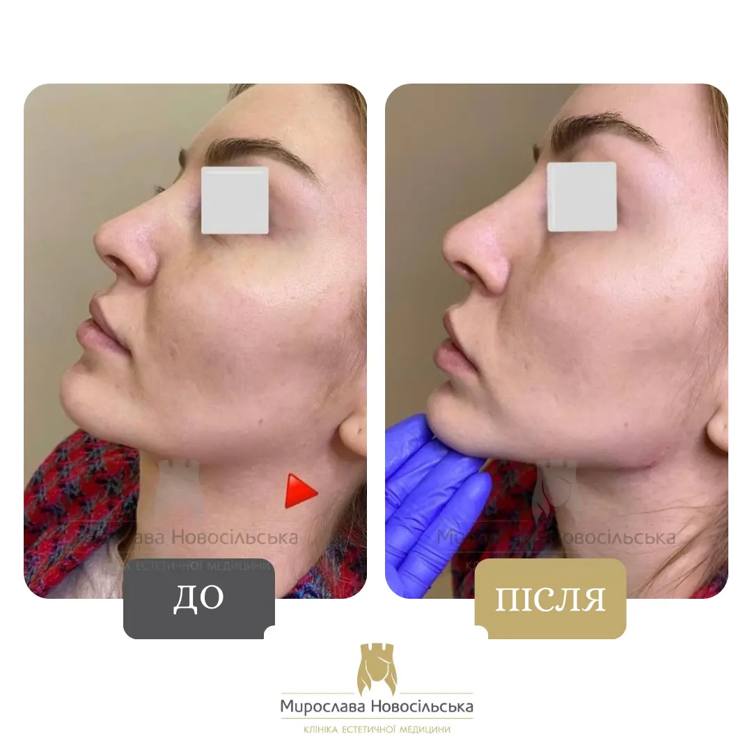 Контурна пластика вилиць, фото 2