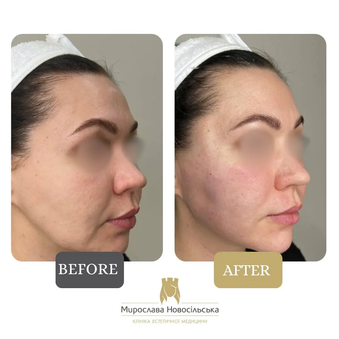 Facial fillers, photo 6