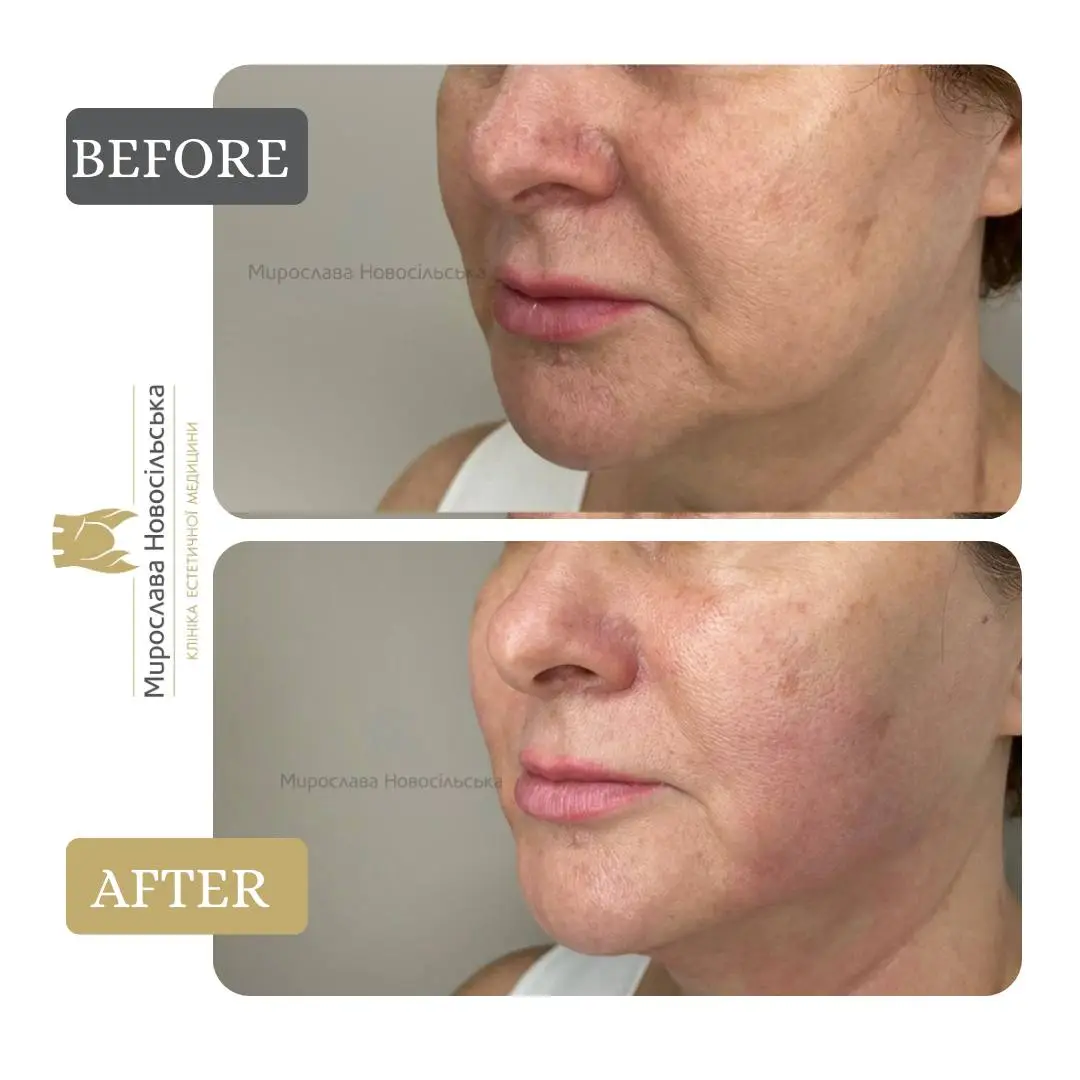 Facial fillers, photo 2