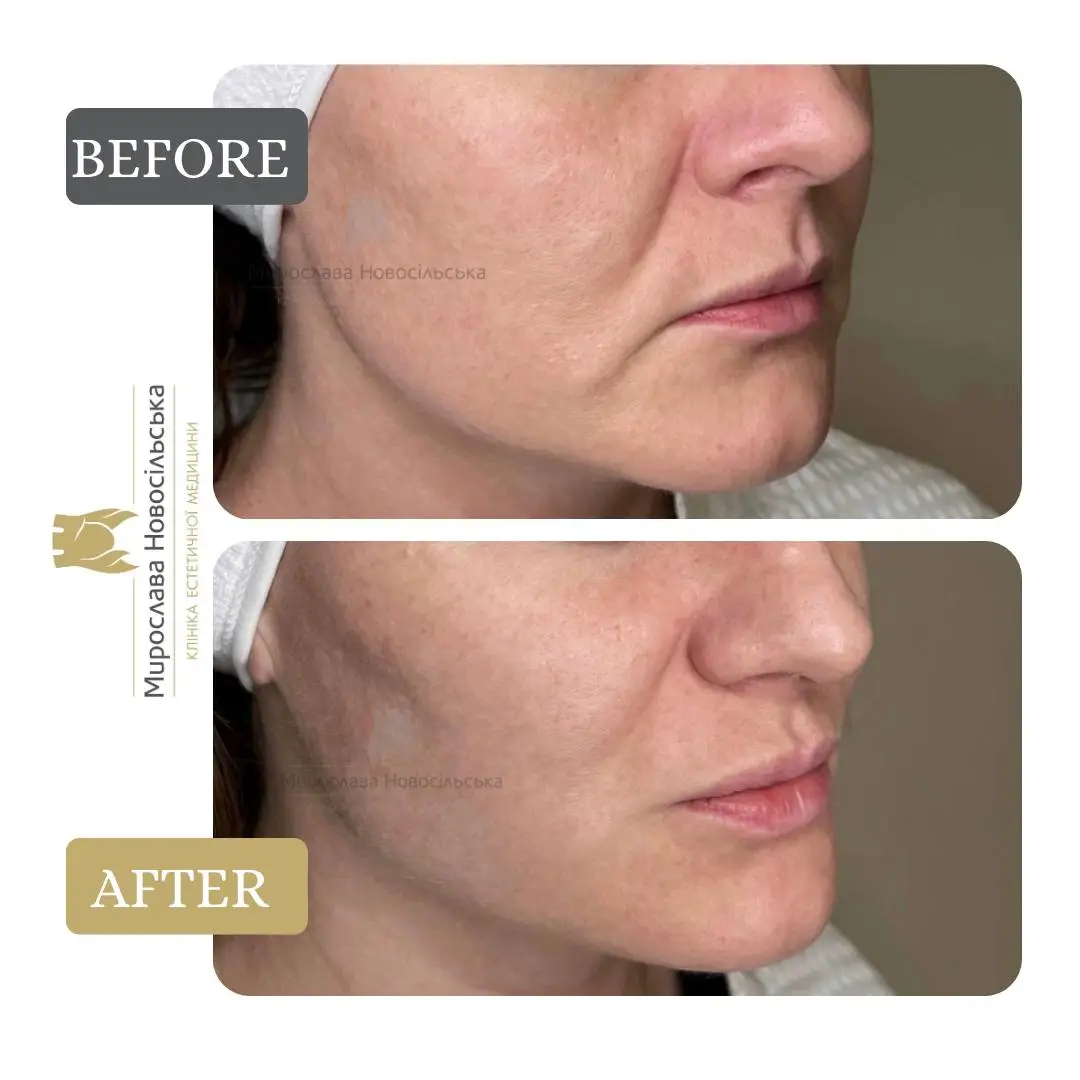 Facial fillers, photo 7