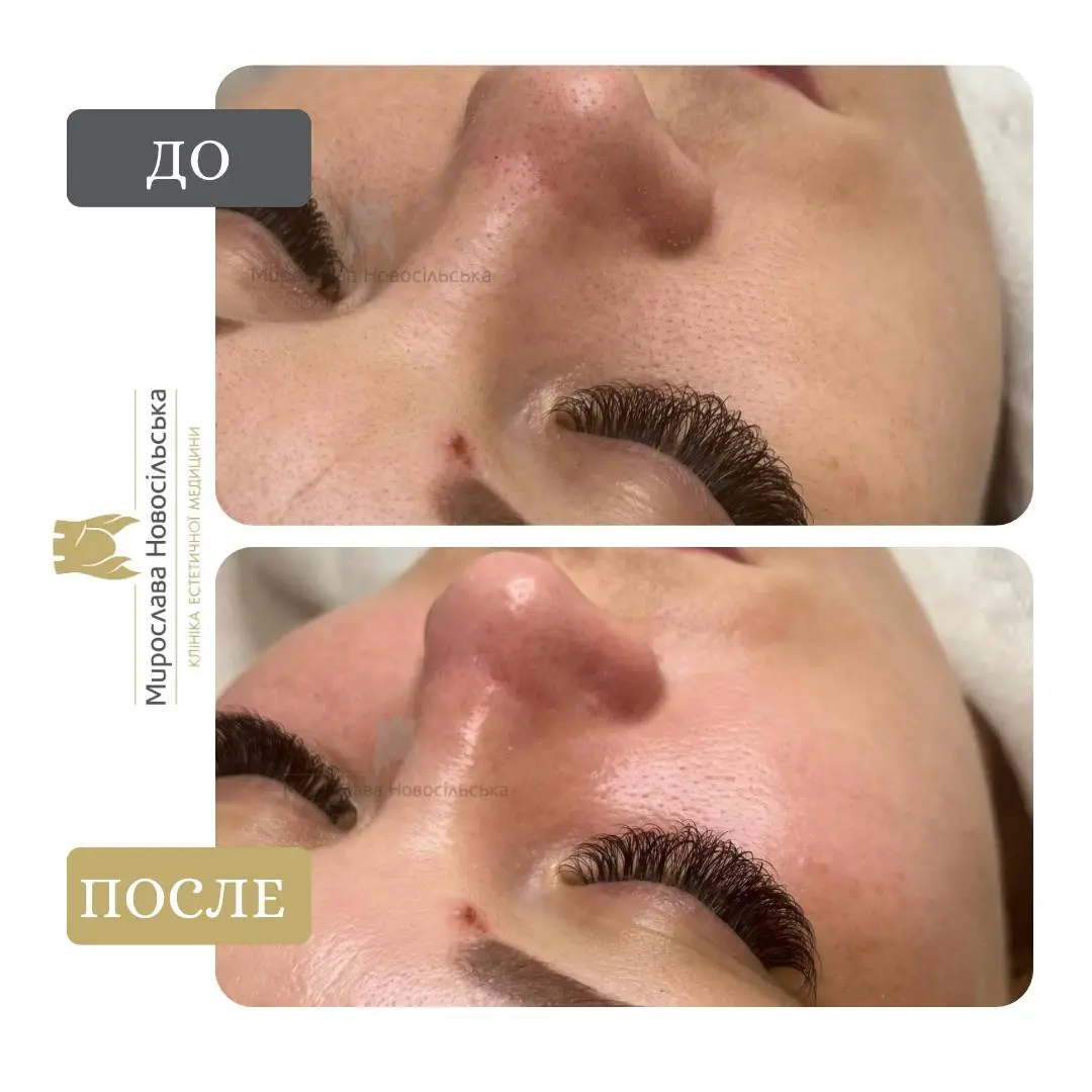 Комбинированная чистка лица, фото 2